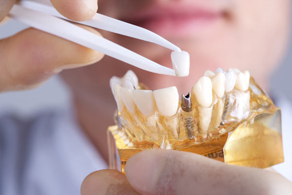 کارنامه و رتبه قبولی ساخت پروتزهای دندانی دانشگاه سراسری